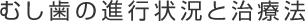 虫歯の進行状況と治療法