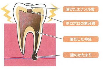 根管治療とは？