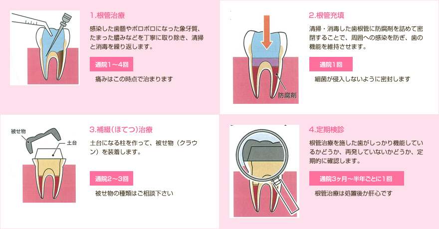 根管治療の手順