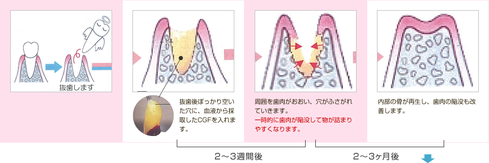 抜歯後の治癒の流れ