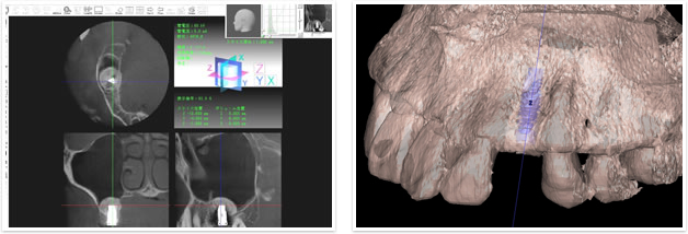 歯科用マイクロCT
