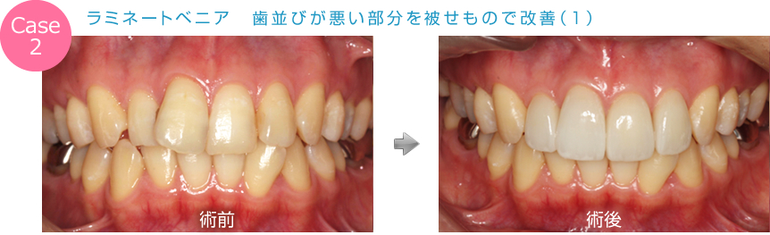 ラミネートベニア　歯並びが悪い部分を被せもので改善（1）