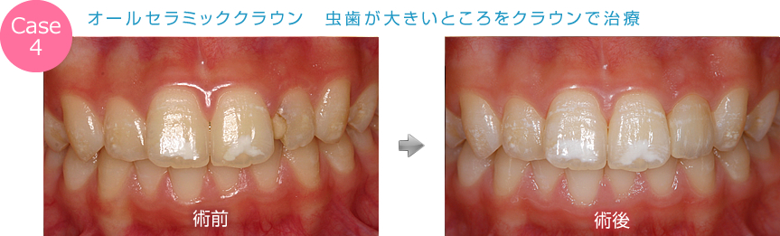 オールセラミッククラウン　虫歯が大きいところをクラウンで治療