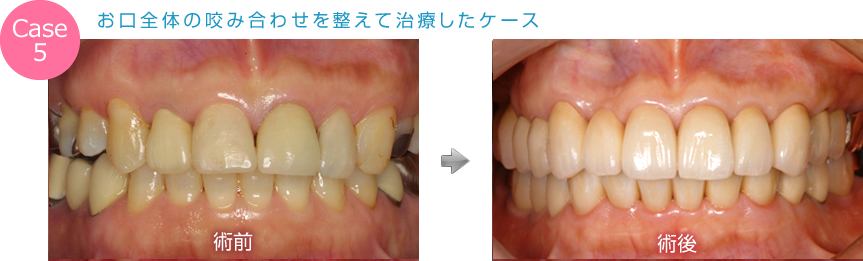 お口全体の咬み合わせを整えて治療したケース