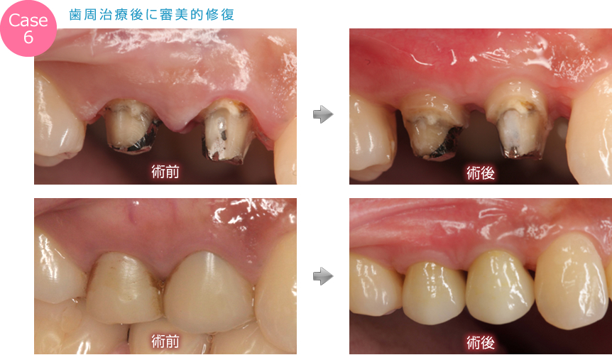 歯周治療後に審美的修復