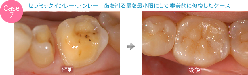 セラミックインレー・アンレー　歯を削る量を最小限にして審美的に修復したケース